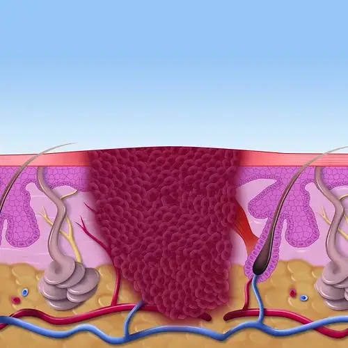 verruca infection diagram