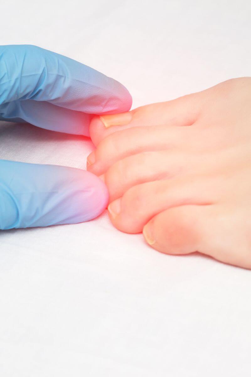 nail surgery for ingrown toenails