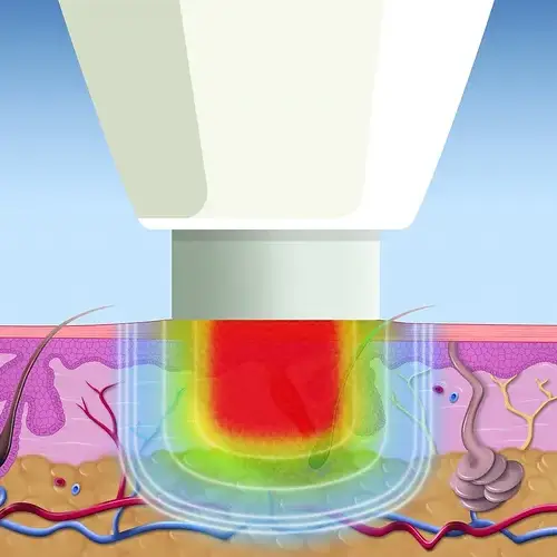 verruca infection diagram for swift microwave treatment