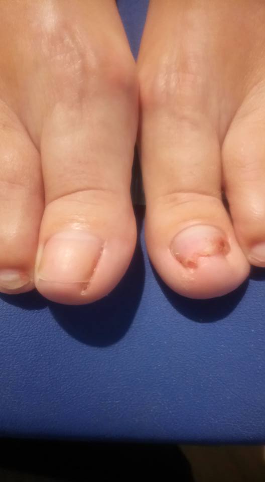 Nail Reconstruction Reid Podiatry