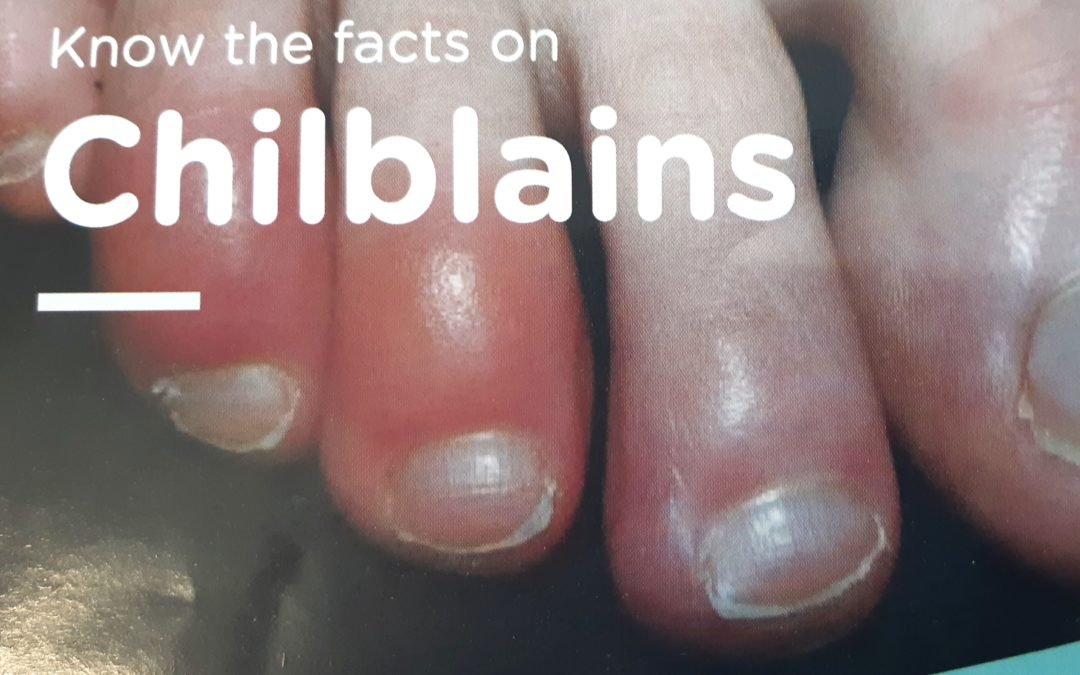 Know the facts on Chilblains