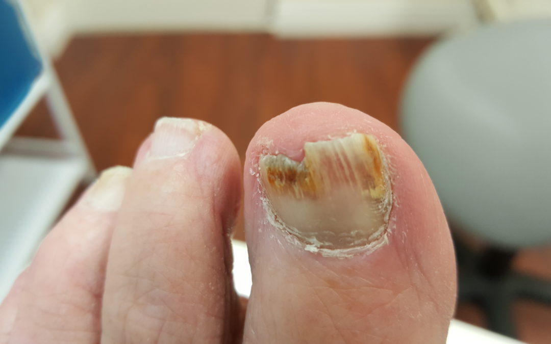 Fungal Toenail Infection Curse or Cure?